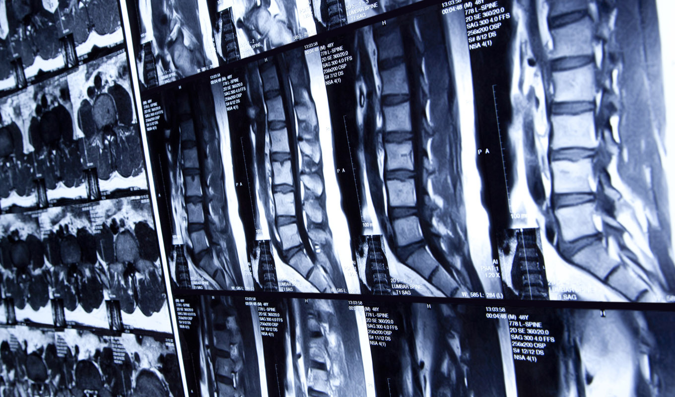 Several x-rays of spines
