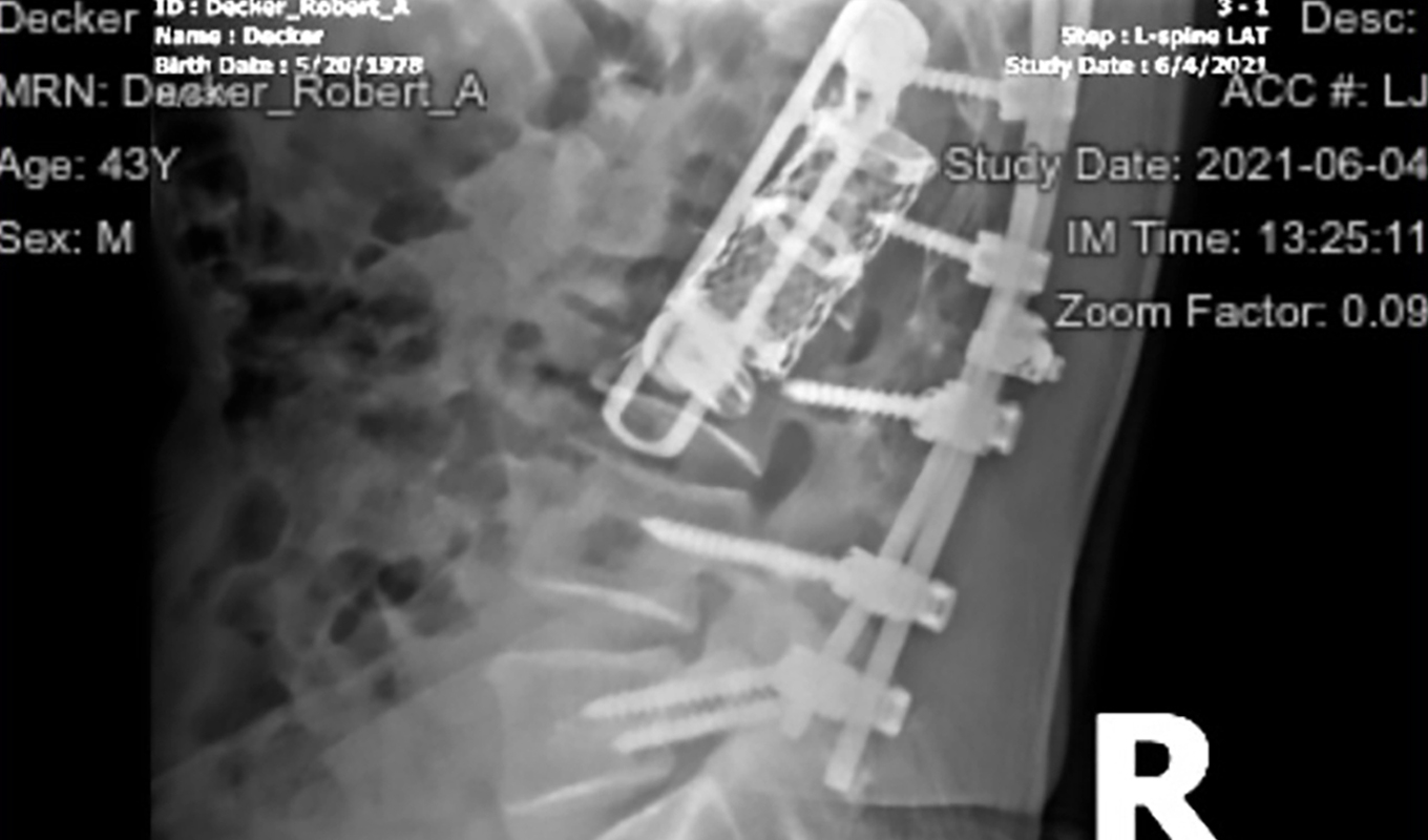 An X-ray shows the hardware that allows Rob Decker to stand and move, although without any curve left in his back.